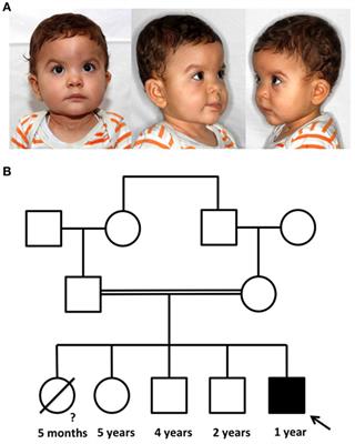 Hematopoietic Stem Cell Transplantation in an Infant with Immunodeficiency, Centromeric Instability, and Facial Anomaly Syndrome